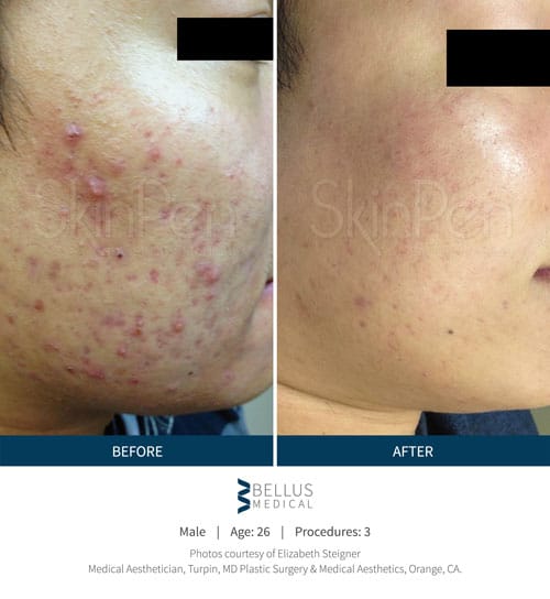 Chiropractic Brookfield WI Skin Pen Before and After Skin
